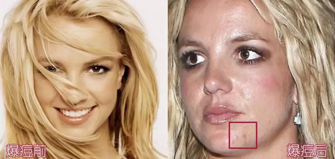战痘技巧｜林允儿和小甜甜的痘痘可不是一回事