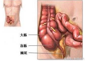 针灸治阑尾炎处方,针灸治疗盲肠炎和阑尾炎