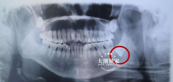 孕期牙疼千万不要忍着,孕期牙疼千万别硬抗