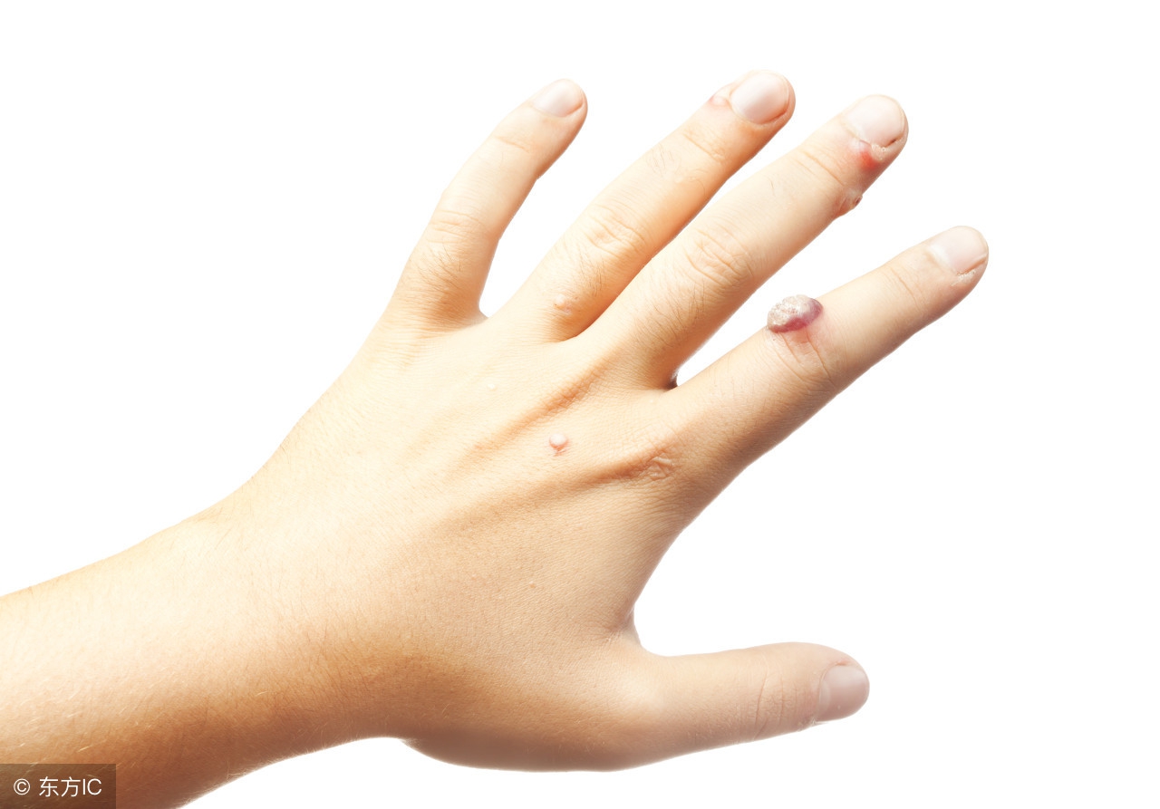 扁平疣最简单去除后怎么护理,扁平疣怎么办教你轻松解决