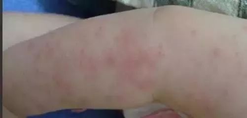 秋季孩子身上痒是什么原因,夏天宝宝身上总是痒怎么回事