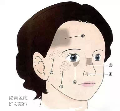 什么斑去除就不再复发了,各种斑淡化最有效的方法