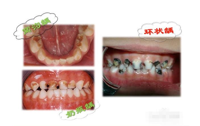 关注儿童牙齿健康不容忽视,对于儿童的牙齿是否重视