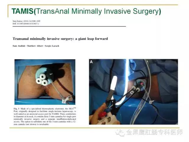 直肠腺瘤绒毛状转变成癌的几率,直肠绒毛腺瘤怎样治疗