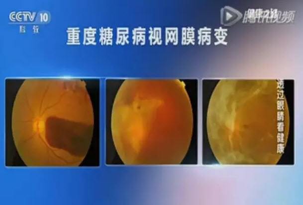 杞菊地黄丸治晚期白内障,杞菊地黄丸治白内障和黄斑病变吗