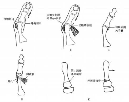 轻中度拇外翻如何矫正,趾外翻是什么引起的