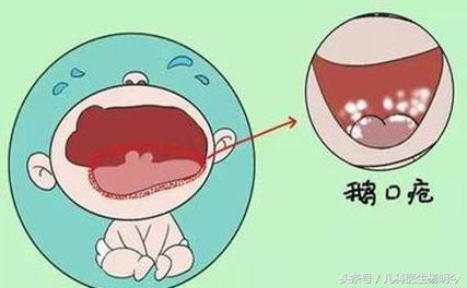 小儿鹅口疮的认知与处理，切勿将鹅口疮与口腔溃疡混淆！