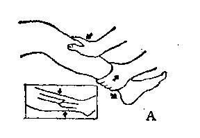 中医骨折治疗原则,中医骨伤整复术