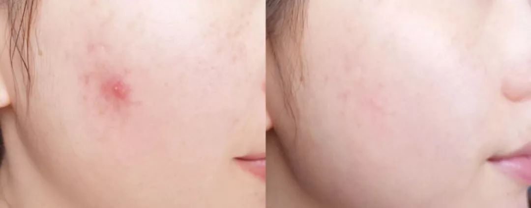 有了全世界3秒卖一瓶的“液体黄金“，干燥、长痘就与你无缘了！