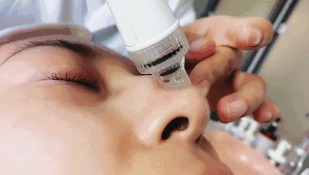 去黑头收缩毛孔的正确方法实测,严重黑头毛孔粗大怎么去除最有效