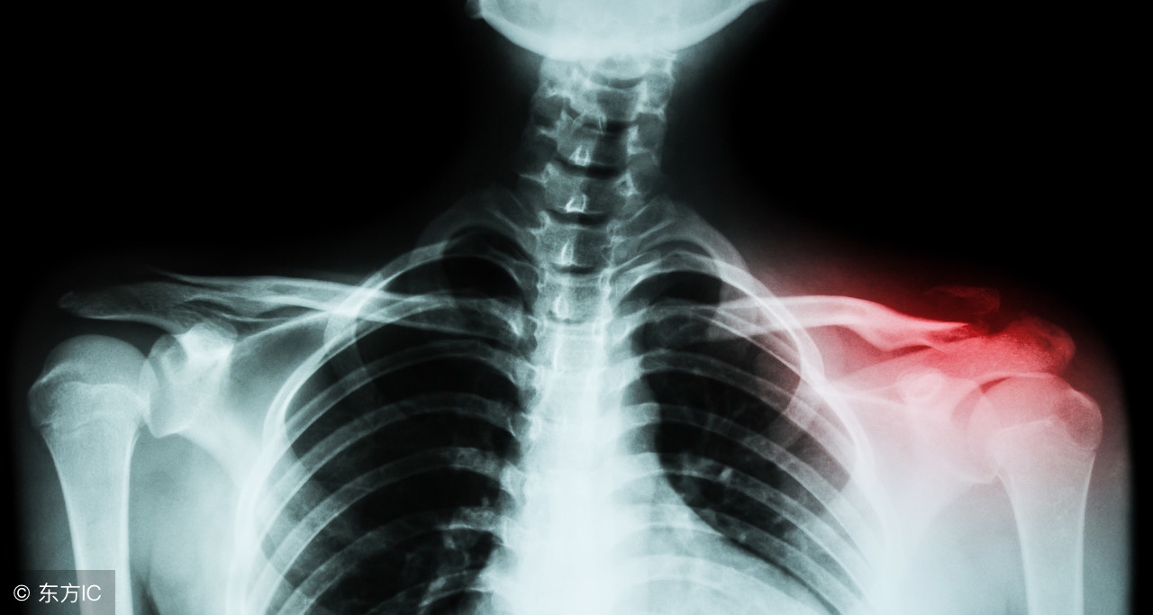 产科的锁骨骨折怎么造成的,幼儿锁骨骨折怎么判断好了呢