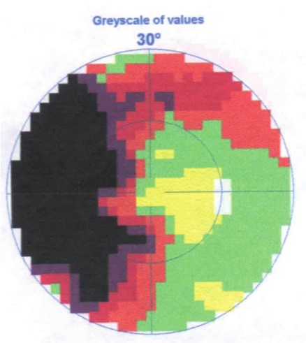 青光眼的知识扩展,青光眼疾病知识