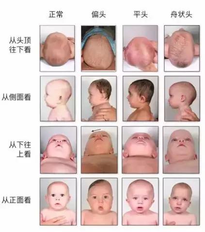 宝宝偏头斜头严重长大了会好吗,宝宝头偏脸歪有什么办法吗