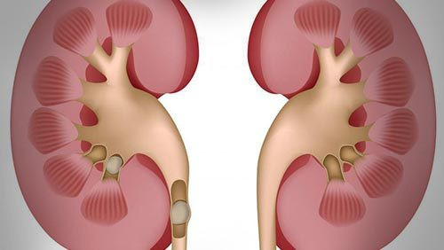 血尿原因有哪些？血尿如何治疗与预防？