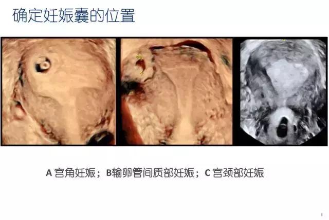 妇科超声波探头,福建省妇幼保健院输卵管超声造影