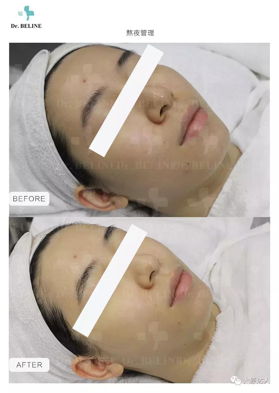 298元！全年无限次黑头管理！Dr.BELINE定制无暇美肌！