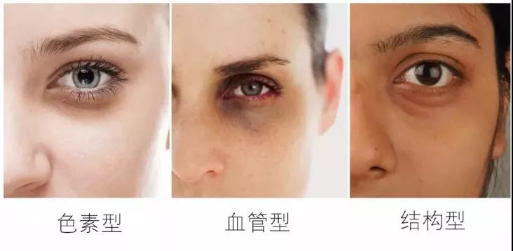 为什么眼睛大会显老？黑眼圈、眼袋、眼纹怎么去除？这两招就够了