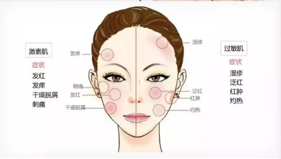 激素脸用的面膜不能含什么成分,激素脸用什么面膜效果最佳