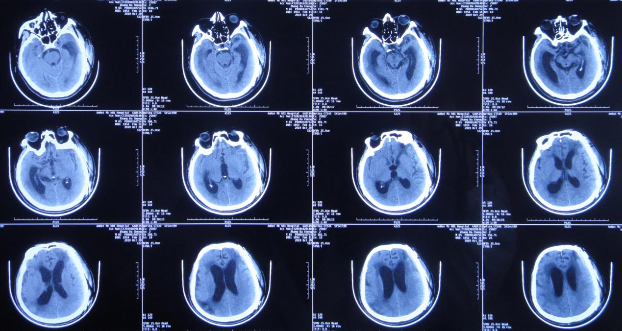颅脑外伤术后脑积水,脑外伤脑积水颅骨缺失