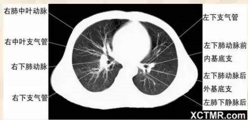 女性盆腔ct断层解剖结构图,女性盆腔脏器ct解剖