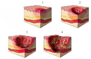 老年人肱骨骨折后该不该手术治疗,老人骨折的症状和治疗方法