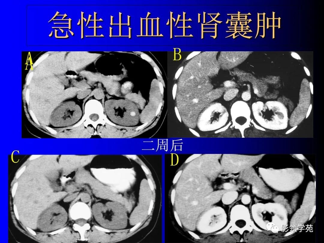 肾脏囊性肿块的影像学特点,肾脏典型病理图片及解析