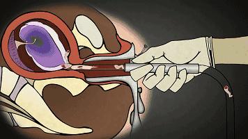 打胎有多可怕案例,20岁女生堕胎7次