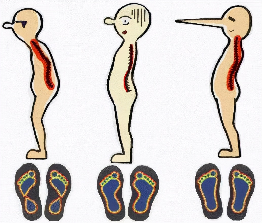 高弓足的保守锻炼治疗方法是什么,高弓足的表现和危害