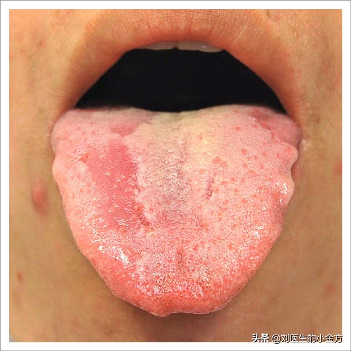 舌象图解大全中医舌诊,最全中医舌诊图谱来了