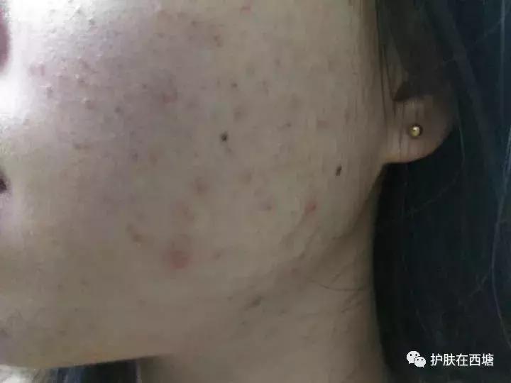 25岁痘痘还是反反复复不好,下巴痘痘反反复复是什么原因