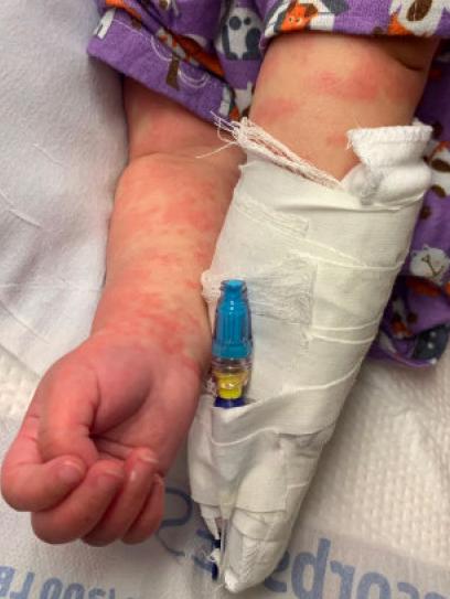 高烧引起的死亡病例,高烧致死的儿童