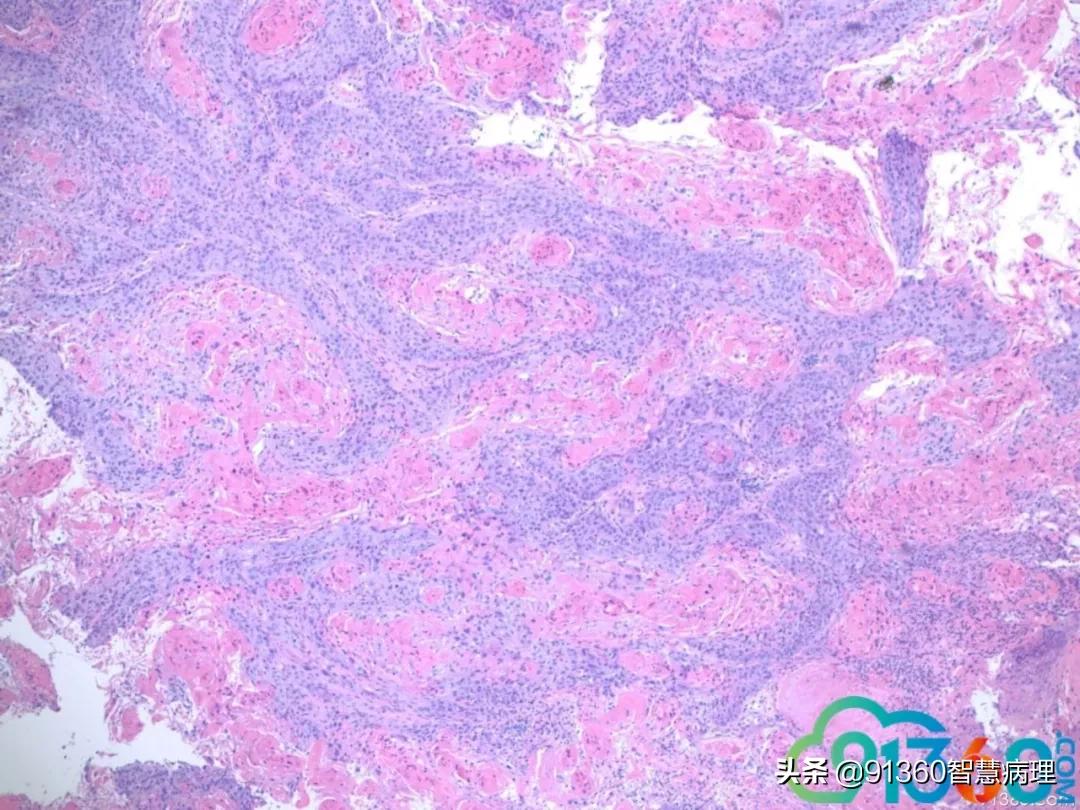 宫颈病理检查与tct检查的区别,病理诊断宫颈活检鳞癌