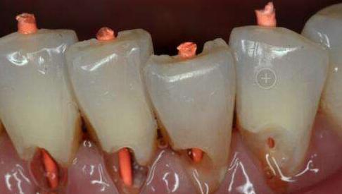 横着刷牙牙齿磨损能补吗,横向刷牙牙根磨损严重怎么修复