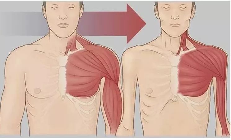 hiv感染都比较消瘦,hiv感染者瘦了有什么影响