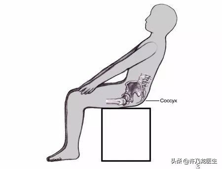 我的尾巴骨一坐下就疼,人体尾巴骨疼咋回事