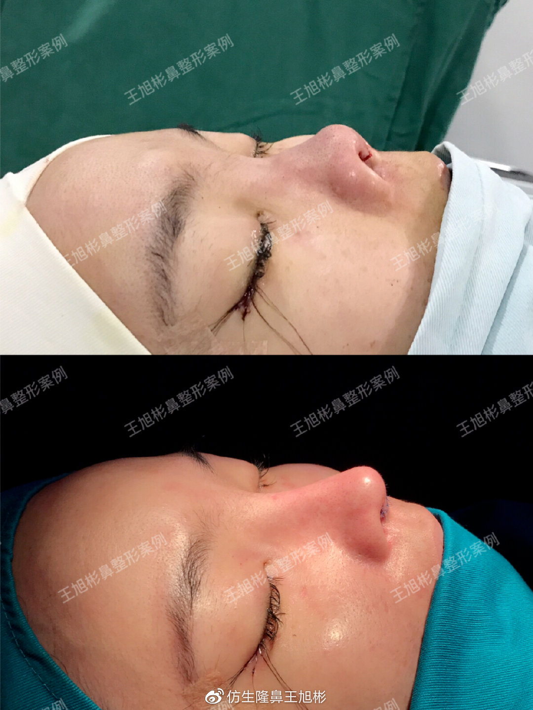 鼻整形最简易方法,鼻孔又大又塌又朝天鼻整形