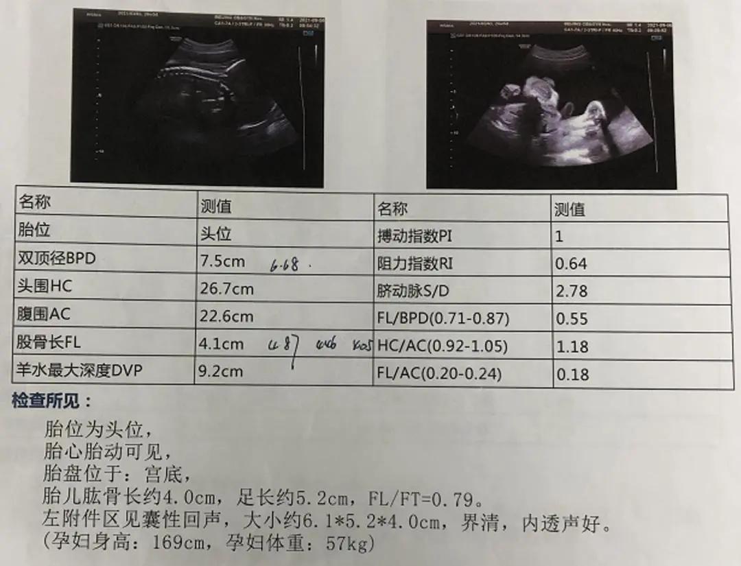 产妇b超显示头部偏大,孕期单纯股骨偏小