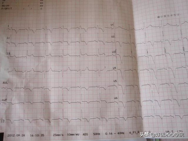 肥厚性心肌病伴心肌梗死,心尖部室壁瘤和心肌穿孔能救活吗