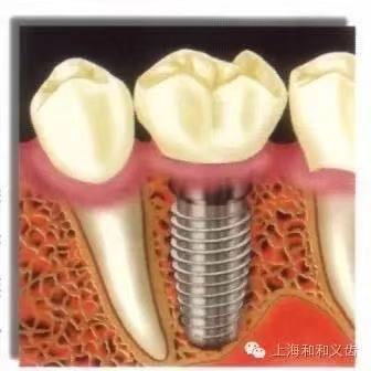 韩国登腾种植牙系统质量怎样,韩国进口登腾种植牙可以用多久