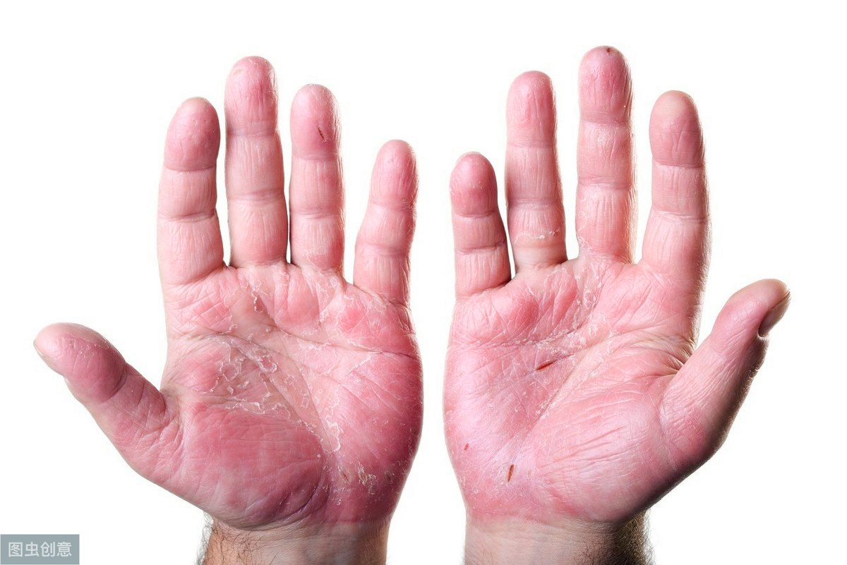 左手大拇指指甲上有褐色的竖纹,指甲上有竖纹代表有糖尿病吗