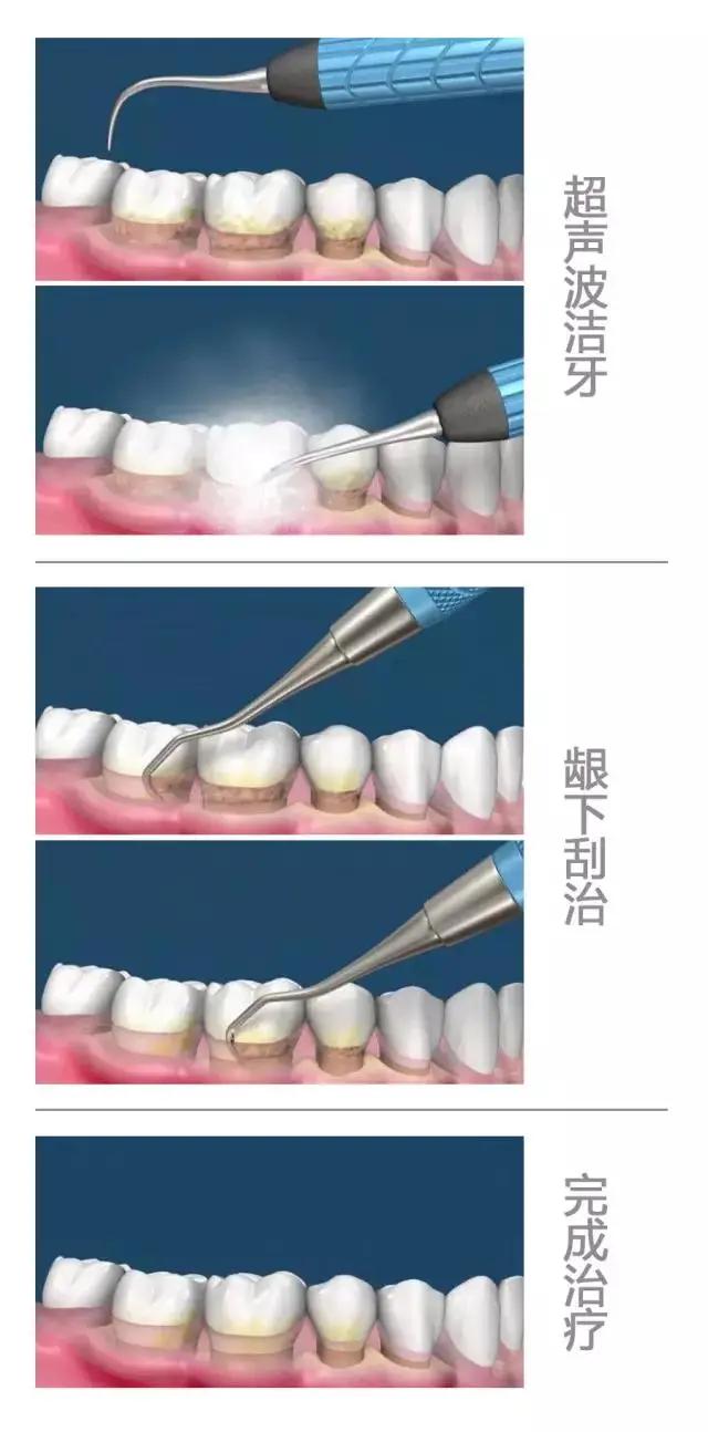孕妇患上牙周病是什么原因,得了牙周病去哪里治疗