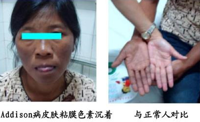 为什么吃一粒激素药长那么胖,激素药致胖