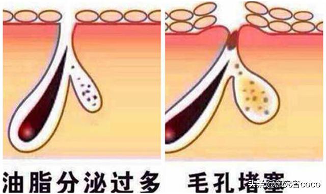 黄金微针做完爆痘怎么办,做完mts微针后爆痘