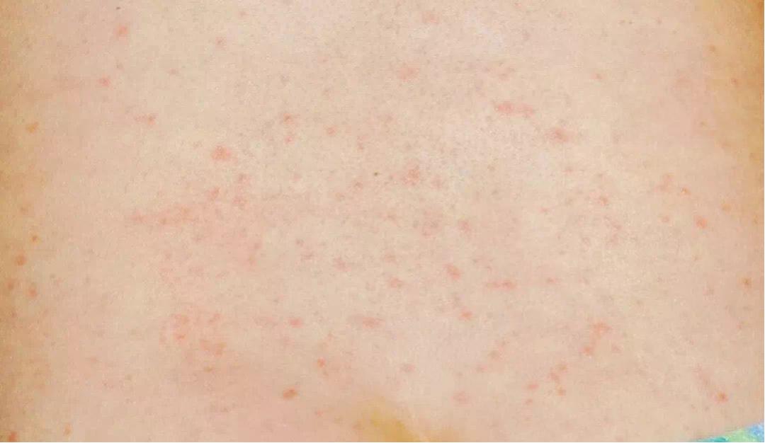 幼儿急疹出疹7天不退反而更多了,婴儿急疹高烧到40.3度不退怎么办