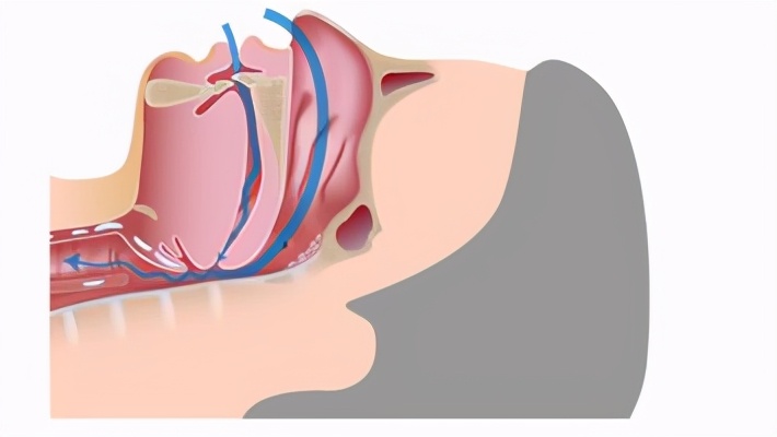 打鼾过程,打鼾呼吸机原理
