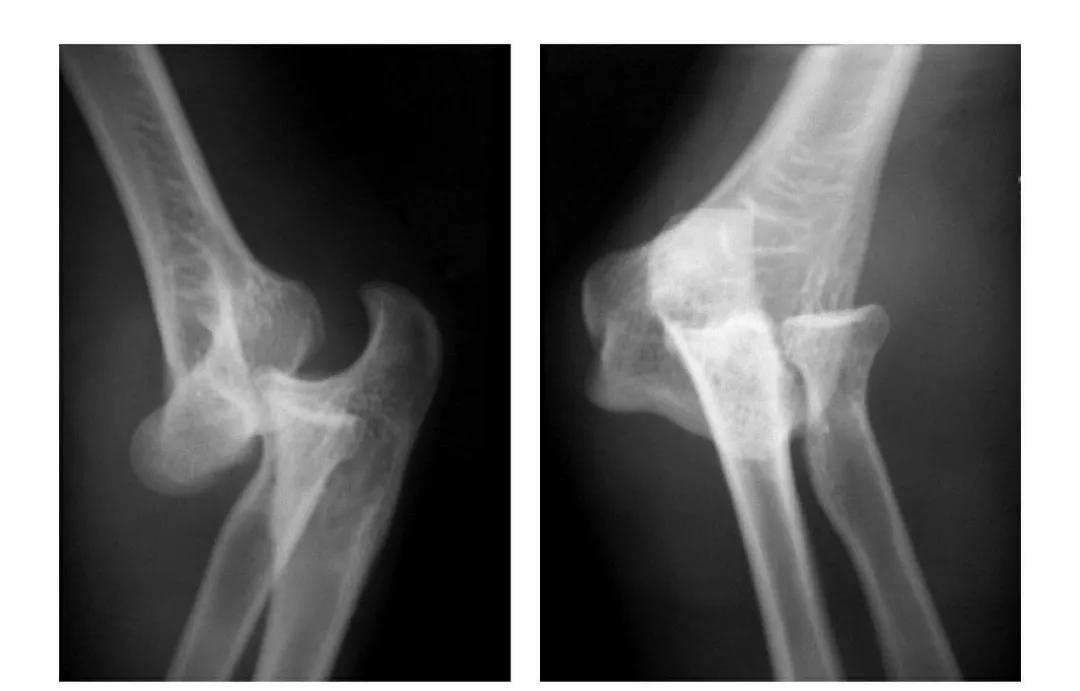 青少年肘部损伤最常见的是,肘部桡神经损伤的临床表现