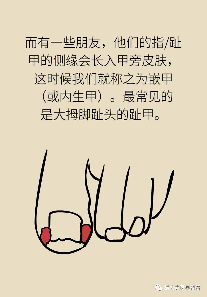 脚趾甲往肉里长怎么治除根,脚趾甲长在肉里面治疗视频