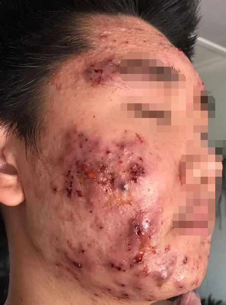 屏障受损起闭口粉刺多长时间能好,不要小看了闭口粉刺