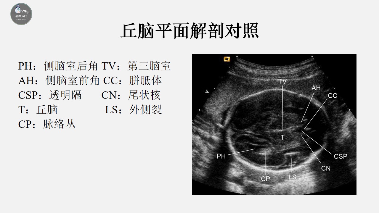 胎儿颅脑超声标准切面图解,胎儿颅脑异常的超声诊断ppt