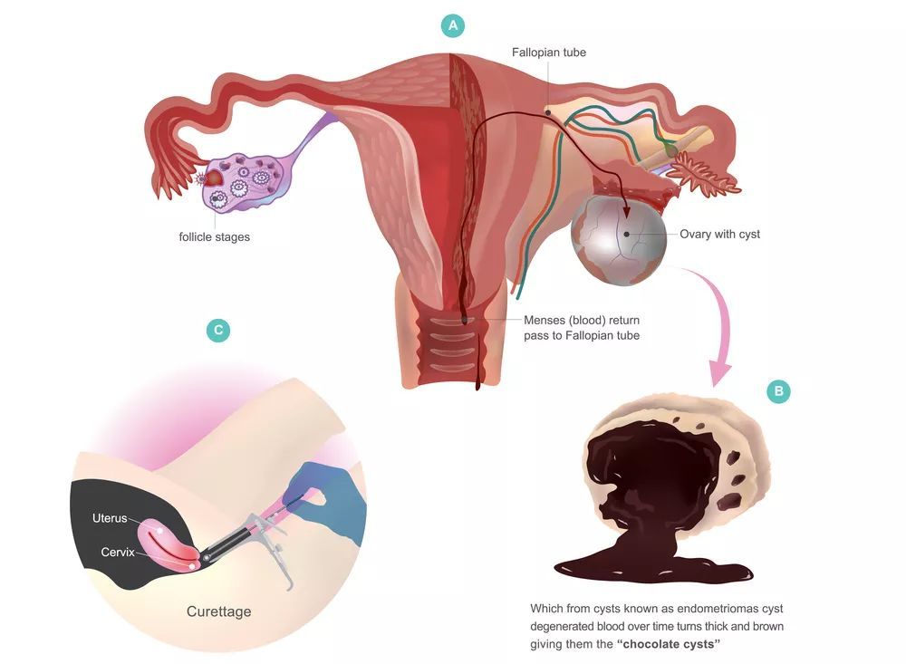 巧克力囊肿微创与穿刺吸收的区别,卵巢巧克力囊肿是微创还是开刀好